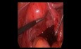 Krew w jamie otrzewnej - ciąża pozamaciczna - laparoskopia