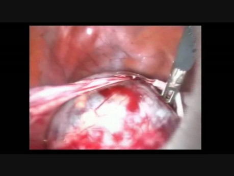 Guz endometrioidalny jajnika- laparoskopia