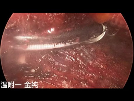 Dwuportowa przezpodobojczykowa endoskopowa operacja tarczycy (część 2)