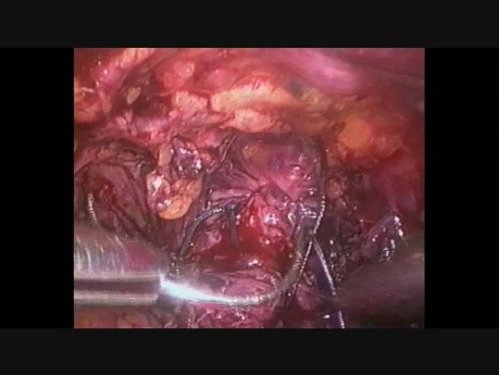 Zespolenie pęcherza z cewką moczową - ostatni szew - laparoskopowa radykalna prostatektomia