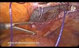 Laparoskopowa obustronna operacja przepukliny pachwinowej