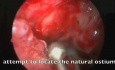 Funkcjonalna endoskopowa operacja zatok - odtwarzanie prawidłowej zatoki szczękowej