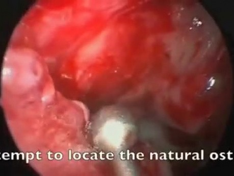Funkcjonalna endoskopowa operacja zatok - odtwarzanie prawidłowej zatoki szczękowej