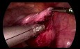 SELS - miomektomia laparoskopowa