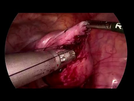 SELS - miomektomia laparoskopowa