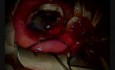 Krwawienie wydalające podczas keratoplastyki penetrującej