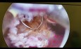 Histeroskopowa resekcja przegrody wewnątrzmacicznej po nawracających poronieniach