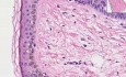 Plama soczewicowata - histopatologia skóry