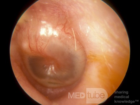Wczesne ostre zapalenie ucha środkowego