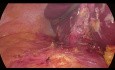 Laparoskopowy drenaż ropnia wątroby (7. segment)  z cholecystektomią u pacjenta z BMI > 70 kg/m2