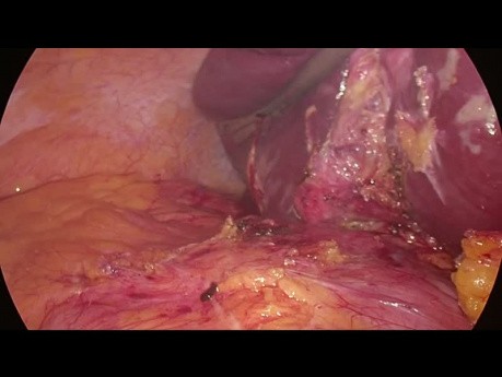 Laparoskopowy drenaż ropnia wątroby (7. segment)  z cholecystektomią u pacjenta z BMI > 70 kg/m2