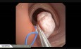 Endoskopowa polipektomia z użyciem pętli elektrochirurgicznej