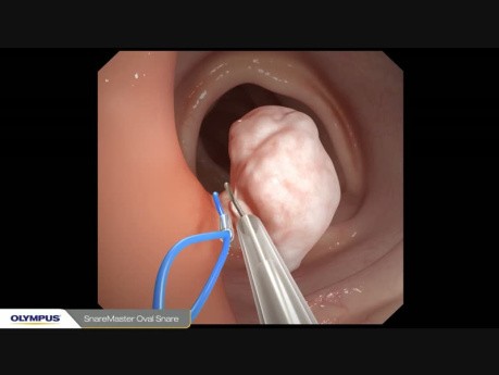 Endoskopowa polipektomia z użyciem pętli elektrochirurgicznej