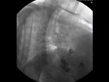 Przełyk Barretta i gruczolakorak połączenia żołądkowo-przełykowego - fluoroskopia 