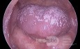 Pleśniawka jamy ustnej (kandydoza)