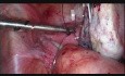 Laparoskopowe leczenie krwiaka jajnika prawego z krwawieniem do jamy brzusznej