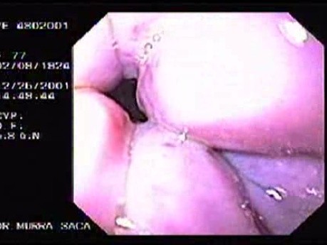 Krwotok - podwiązywanie żylaków przełyku (gumowa opaska) - wprowadzenie endoskopu
