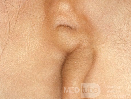 Mikrotia ucha lewego 