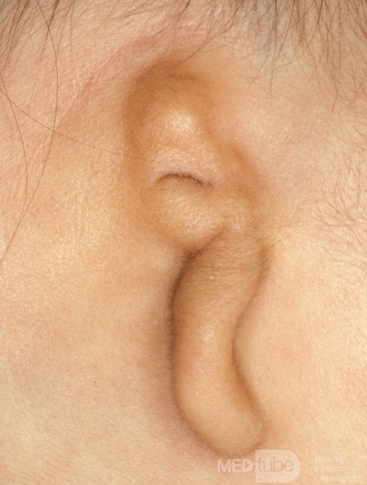 Mikrotia ucha lewego 