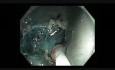 Kolonoskopia - resekcja dużego płaskiego polipa