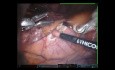 Resekcja guza śródpiersia z dojścia podmostkowego i bocznego