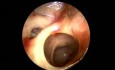 10 dni po zabiegu FESS (Functional Endoscopic Sinus Surgery)