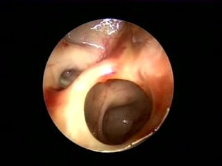 10 dni po zabiegu FESS (Functional Endoscopic Sinus Surgery)