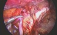 Laparoskopowa operacja żylaków powrózka nasiennego po stronie lewej