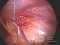 Anatomia kanału pachwinowego w widoku laparoskopowym