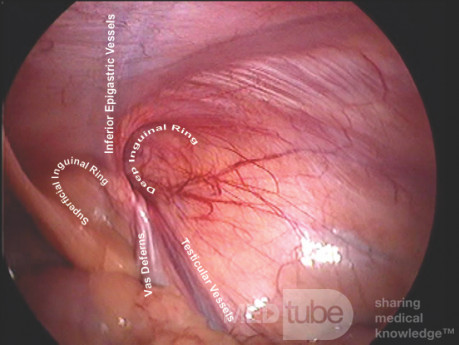 Anatomia kanału pachwinowego w widoku laparoskopowym