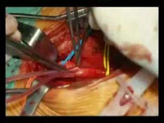 Endarterektomia tętnicy szyjnej