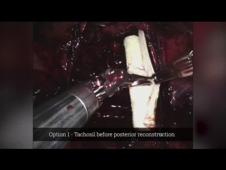 TachoSil and Quill in Robot Assisted Nerve-sparing Radical Prostatectomy