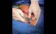 Chest Wall Reconstruction with Plate and Screw