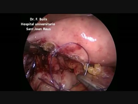 Laparoskopowa naprawa jatrogennej perforacji po kolonoskopii