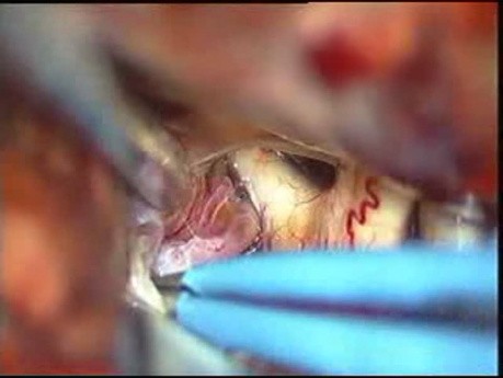 Klipsowanie tętniaka tętnicy łączącej przedniej mózgu - przypadek 2