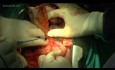 Wycięcie żołądka z limfadenektomią D2 z powodu gruczolakoraka okolicy przejścia przełyku w żołądek