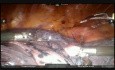 Mięsakorak (Carcinosarcoma) oskrzela lewego