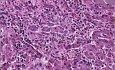 Cytomegalia - Wrodzone zakażenie wirusem 