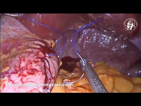 Laparoskopowa rękawowa resekcja żołądka z omentopeksją i unieruchomieniem tylnej ściany żołądka w celu repozycji pozostałości żołądka