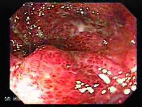 Wrzodziejące zapalenie jelita grubego typu pancolitis (3 z 7)
