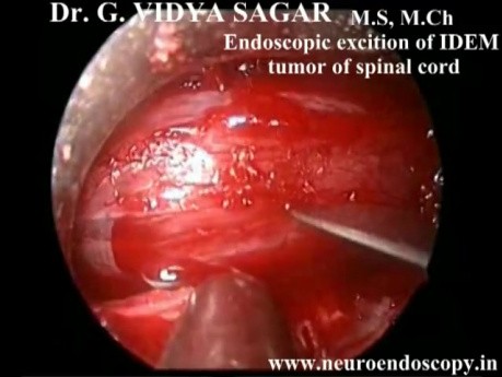 Endoskopowe usunięcie guza rdzenia kręgowego