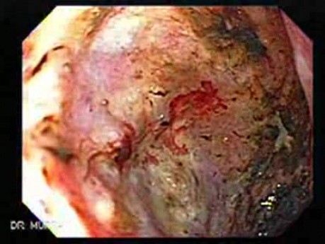Rak gruczołowy jamy odźwiernikowej z naciekaniem dwunastnicy (3 z 3)