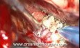 Mikrochirurgiczne usunięcie oponiaka zlokalizowanego na podstawie czaszki w obrębie grzbietu siodła