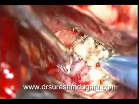 Mikrochirurgiczne usunięcie oponiaka zlokalizowanego na podstawie czaszki w obrębie grzbietu siodła