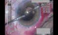 Operacja zaćmy w oku z wykonaną trabekulektomią 2