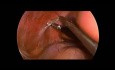 Adrenalektomia laparoskopowa u dziecka