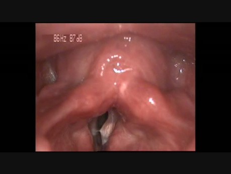 Torbiel strun głosowych (1)