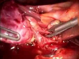 Zapalenie pęcherzyka żółciowego- operacja metodą laparoskopową