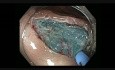 Kolonoskopia - usunięcie zmiany w okolicy zgięcia wątrobowego