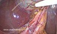 Ciekawostka anatomiczna: gdy zrosty nadają pęcherzykowi żółciowemu nieoczekiwany kształt